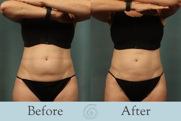 Liposuction Before and After 22 - Front