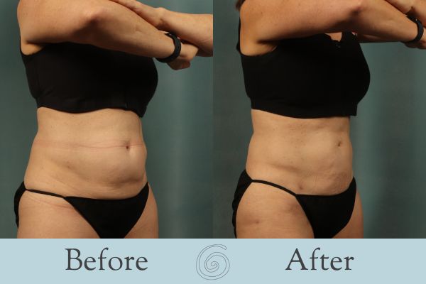 Liposuction Before and After 22 - Side