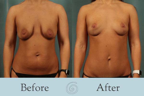 Breast Lift Before and After 15 - Front