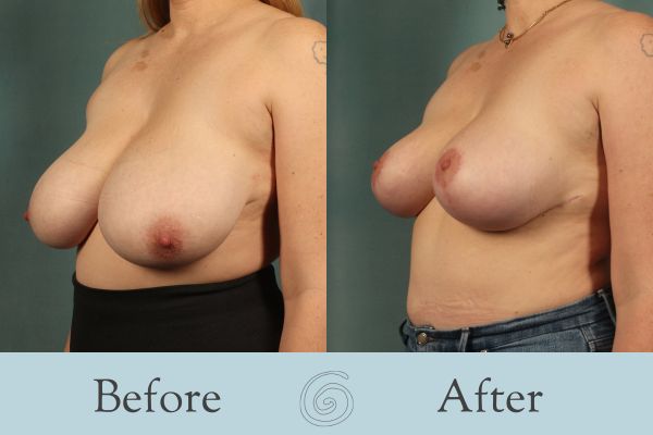 Breast Reduction Before and After 32 - Side