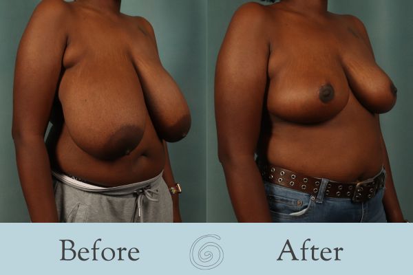 Breast Reduction Before and After 33 - Side