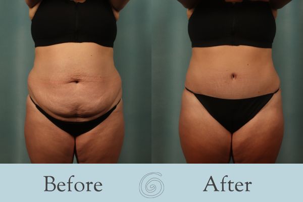 Tummy Tuck Before and After 48 - Front