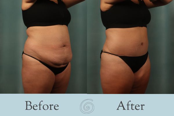 Tummy Tuck Before and After 48 - Side