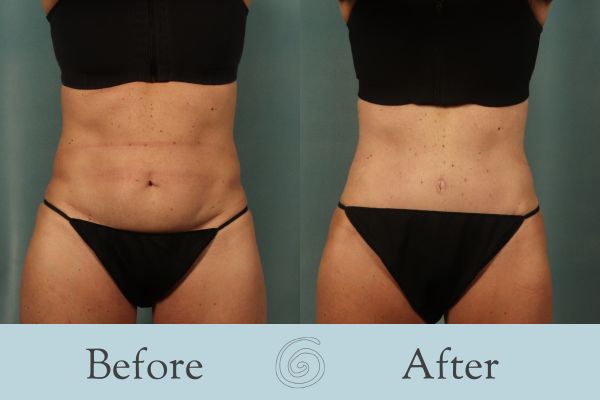 Tummy Tuck Before and After 49 - Front