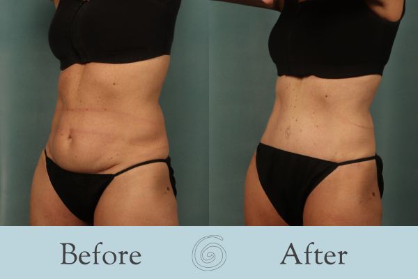 Tummy Tuck Before and After 49 - Side