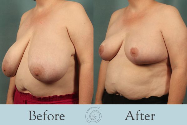 Breast Reduction Before and After 34 - Side