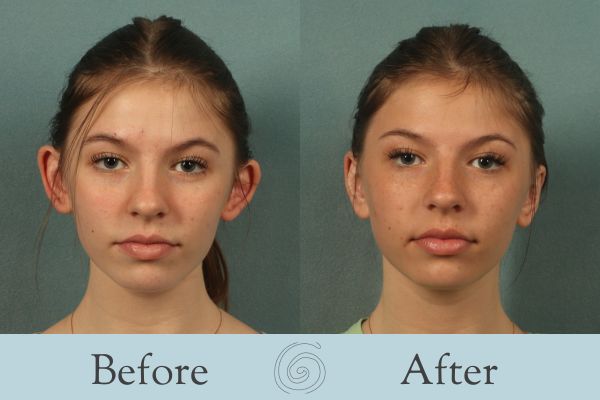 Otoplasty Before and After 1 - Front