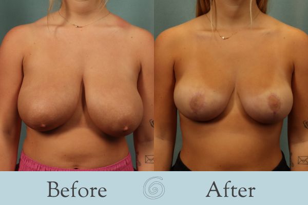 Breast Reduction Before and After 35 - Front