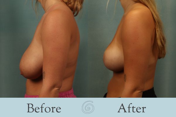 Breast Reduction Before and After 35 - Side