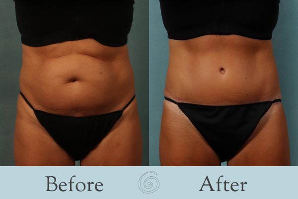 Tummy Tuck Before and After 51 - Front