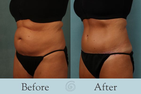 Tummy Tuck Before and After 51 - Side