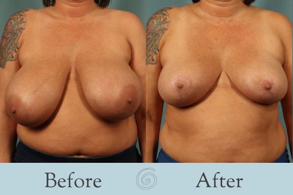Breast Reduction Before and After 36 - Front