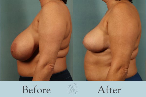 Breast Reduction Before and After 36 - Side