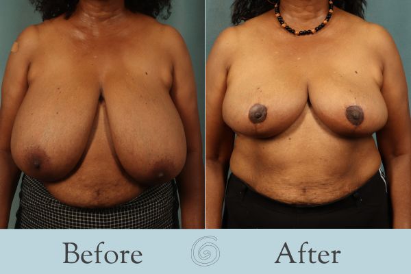 Breast Reduction Before and After 37 - Front