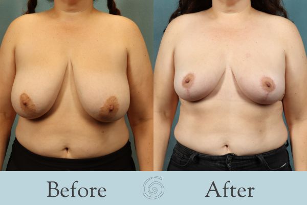 Breast Reduction Before and After 38 - Front