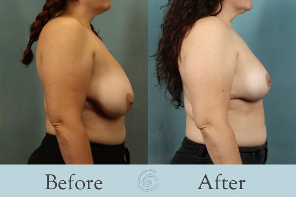 Breast Reduction Before and After 38 - Side