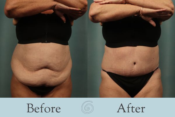 Tummy Tuck Before and After 53 - Front