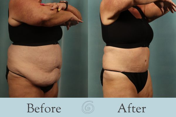 Tummy Tuck Before and After 53 - Side