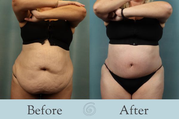 Tummy Tuck Before and After 54 - Front