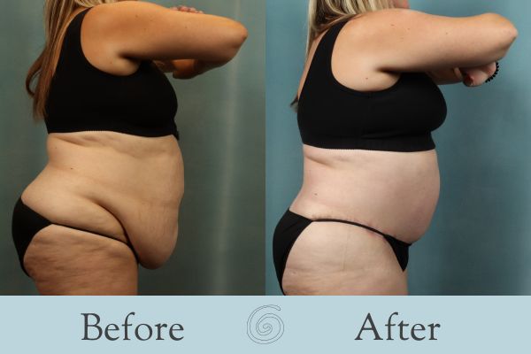 Tummy Tuck Before and After 54 - Side