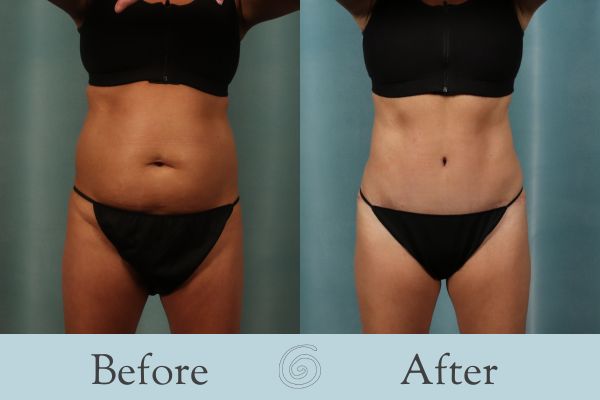 Tummy Tuck Before and After 55 - Front