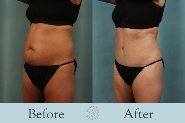 Tummy Tuck Before and After 55 - Side
