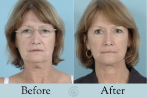 before and after of a facelift on a older women