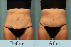 women before and after of tummy tuck
