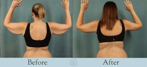Arm Lift Before and After 3