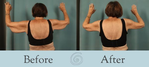 Arm Lift Before and After 4