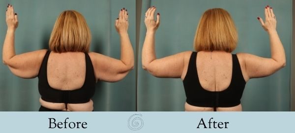 Arm Lift Before and After 5