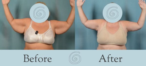 Arm Lift Before and After 7