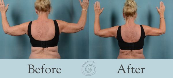 Arm Lift Before and After 8