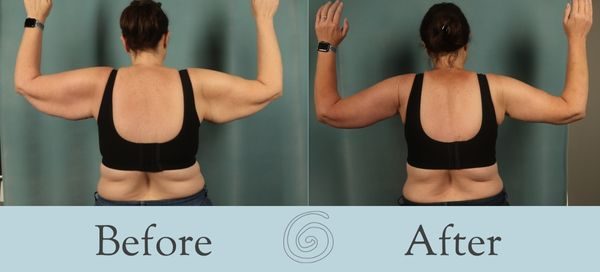Arm Lift Before and After 9